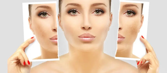 Prevent Hyperpigmentation- Matia Natural